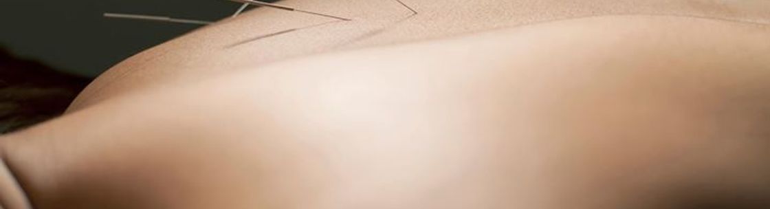 Birchwood Acupuncture, Eagan MN