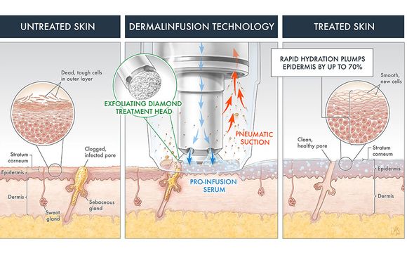 Microderm Infusion by Que Liinda La Vida (QLE) in Federal Way, WA ...
