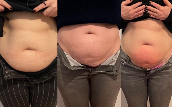 Reduced prices on Cryoskin packages  with Jen Gallagher LE