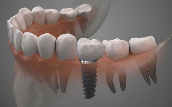 Free Implant consultation and $300.00 off treatment by Nouel ...