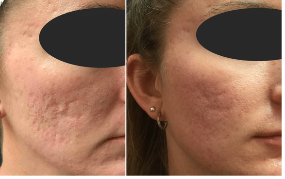 $40 off Sublative Ematrix by Executive Skin and Laser in The Villages ...