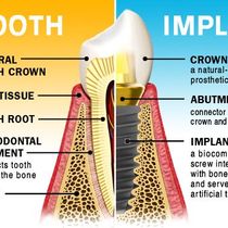 What Are Dental Implants? with Howard M. Steinberg, DMD, MDS