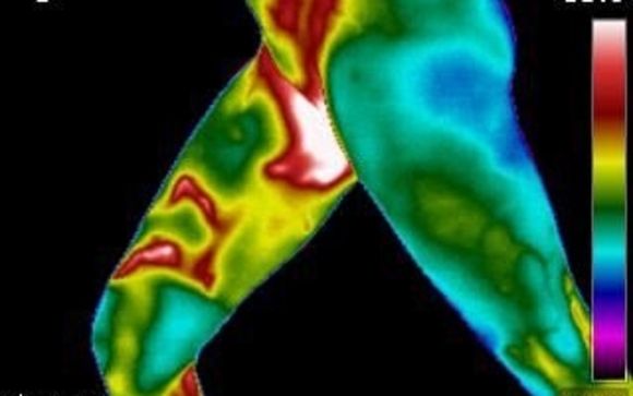Thermography Breast and Health Assessment by Hindsight Thermography Clinic