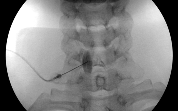 Stellate Ganglion Sympathetic Blocks by Virginia Interventional Pain ...