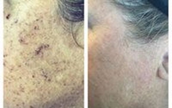 Photofacial IPL by Revitalize Studio in Goodyear AZ Alignable