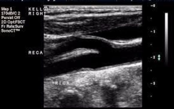 Carotid Artery Anatomy Ultrasound