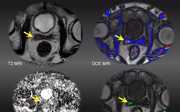 3 TESLA MRI PROSTATE