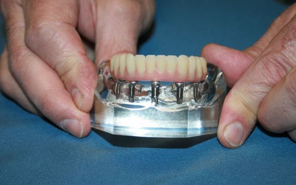 Dental Implants by Dr. Richard Wolfert - The Toothboss