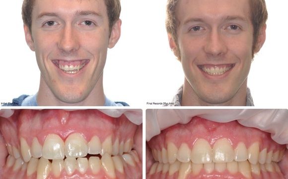 Corrective Jaw Surgery By Texas Oral And Maxillofacial - 