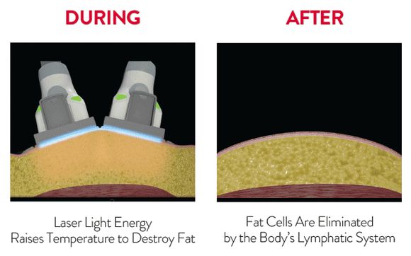 Love Handles Fat Reduction