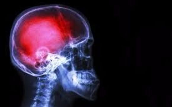 Headache and Migraine by Healing Source Physical Therapy