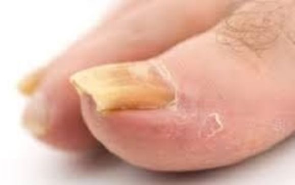 Thick nails by Seneca Medical Foot Care