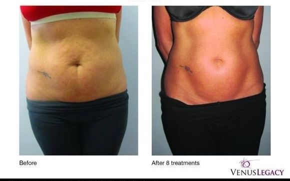 Body Contouring and Skin Tightening by Tat 2 Undo