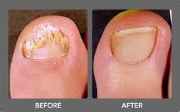 Laser Nail Fungus Removal by Tat 2 Undo