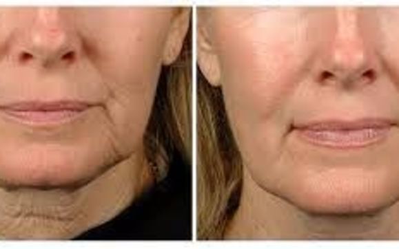 Thermage by Skin Solutions