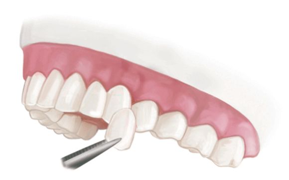 Porcelain Veneers – Paris Family Dental by Paris Family Dental