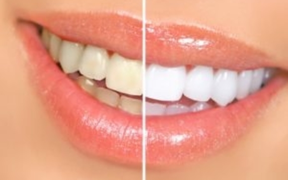 Express Teeth Whitening  by SmileSketchVegas.com