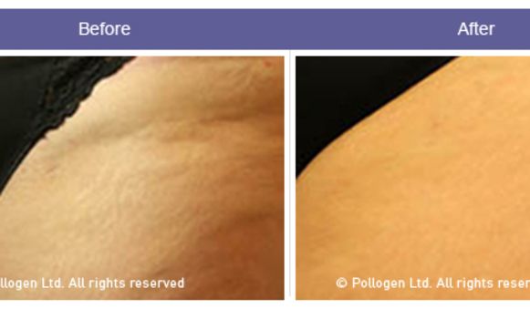 Newest Cellulite Solution Now Available At Elite By Elite Laser