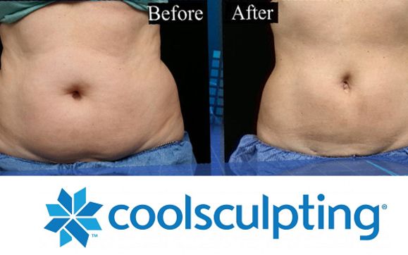 CoolSculpting by Suddenly Slimmer Med Spa