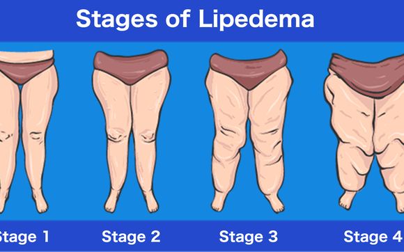 Lipedema Treatment by Pain & Swelling Solutions Lymphatic Massage for  Plastic Surgery Recovery in Albuquerque, NM - Alignable