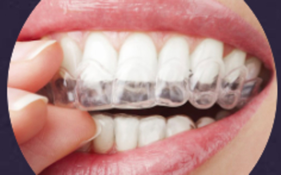 Invisalign by Midtown Dental Excellence in New York, NY - Alignable