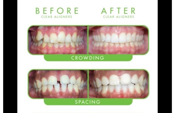 Clear Correct  by The Smile Shapers- Levesque,Allen Dr.