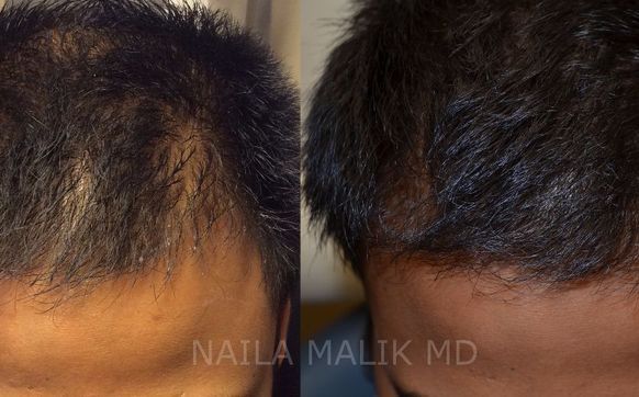 PRP + ACell Hair Regeneration by Naila Malik MD PA in Dallas, TX - Alignable