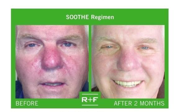 Outlet Rodan & Fields Soothe Regimen