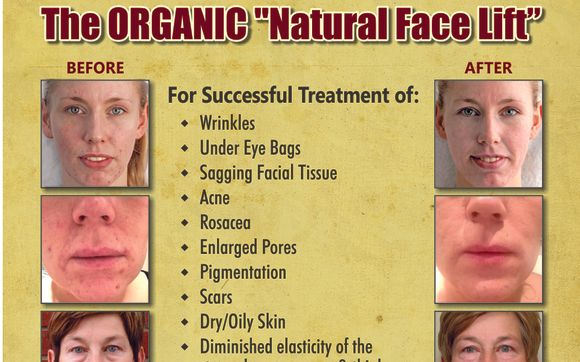 What is a Natural Face Lift?