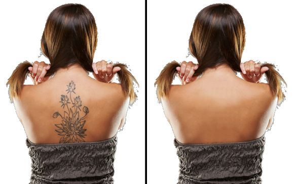 Laser Tattoo Removal by Vanish Inc. in Williamsport PA Alignable