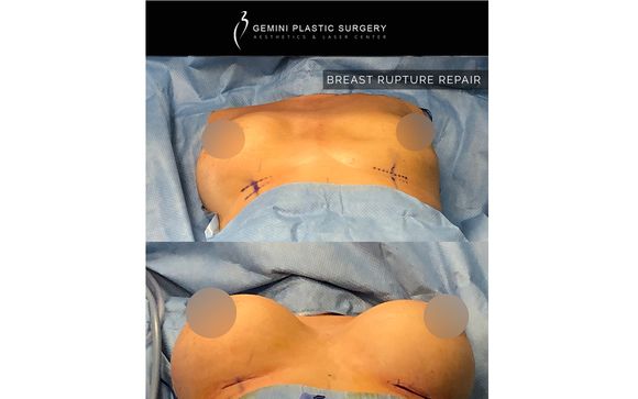 Breast Augmentation in Rancho Cucamonga