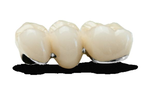 PFM Crowns by JU Genesis LAB | JU Dental LAB 