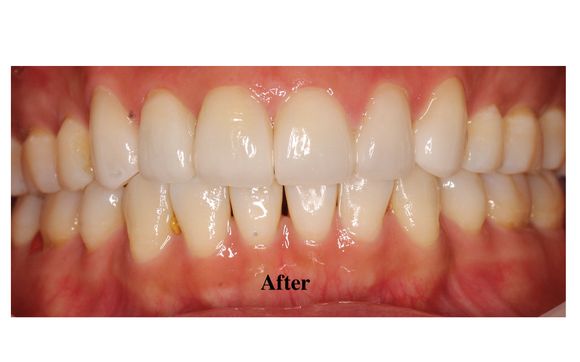Prettau Zirconia Crowns by JU Genesis LAB | JU Dental LAB 