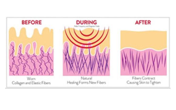 Radio Frequency Body Sculpting