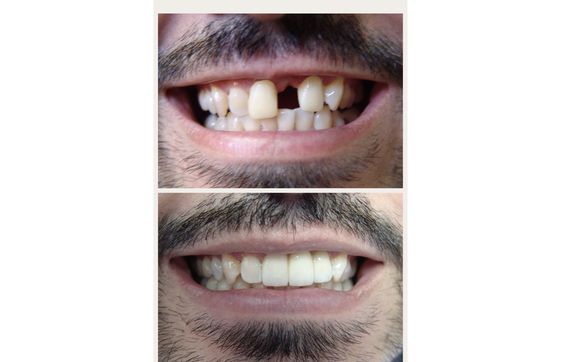 Dental Implant By Cohen Dental Care Dr Behnam Cohen Dds In