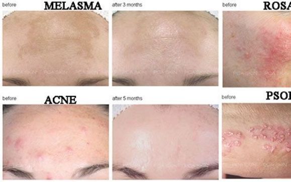 Chemical Peel In Atlanta