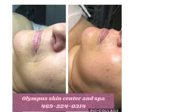 Facials Skincare Services Body Wrap And More By Olympus Skin Center Spa In Plano Tx Alignable