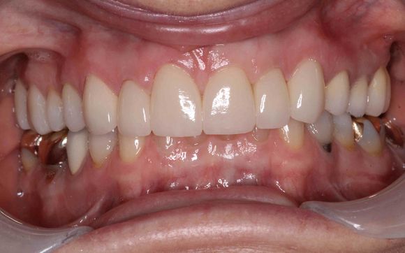 Cosmetic Veneers by Sandor Family Dentistry