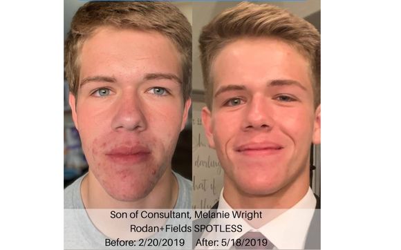 Spotless Regimen for Teenage Acne