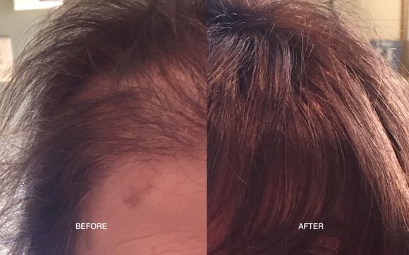Alopecia Solutions By Suisse Natural Hair Salon In Newton Ma