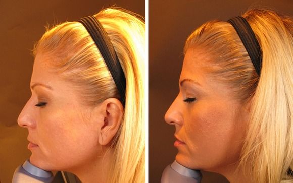 Non Surgical Nose Job