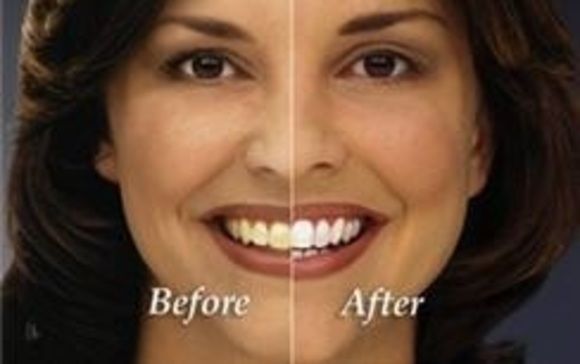 Teeth Whitening (ZOOM) by Total Dentistry
