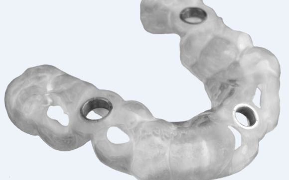 CAD/CAM Surgical Guide by Implant Concierge in San Antonio, TX - Alignable