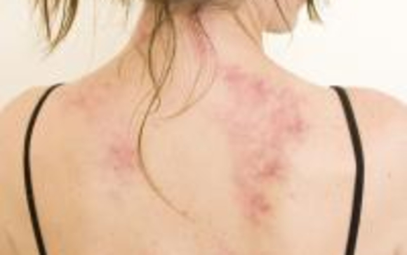 Dermal friction therapy (Gua Sha) by Lumina Wellnes and Rejuvenation in ...