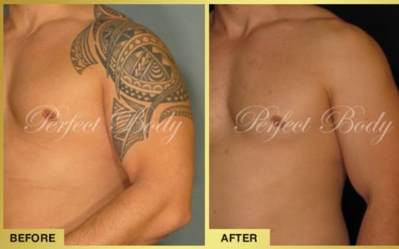 Laser Cellulite Removal Experts - Perfect Body Laser & Aesthetics® - Long  Island, NY