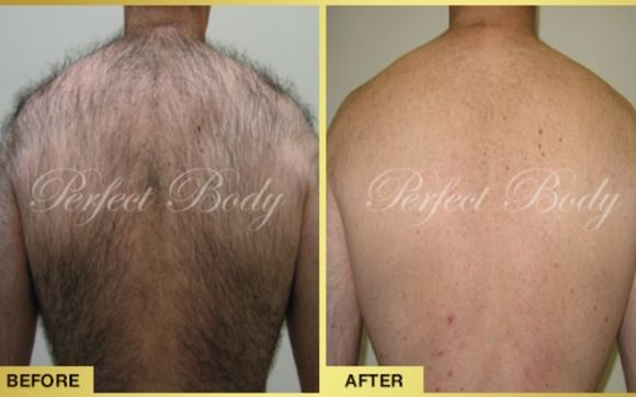 The Best Laser Hair Removal On Long Island by Perfect Body Laser