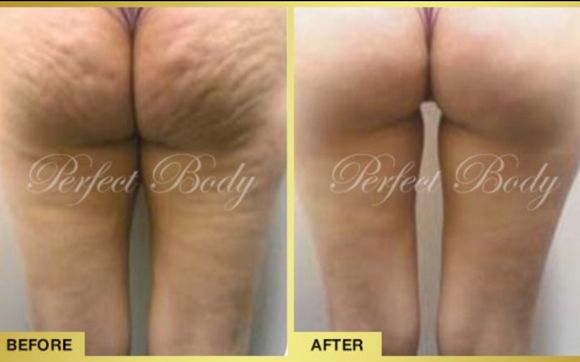 Cellulite treatment NYC  Cellulite nyc & what is cellulite