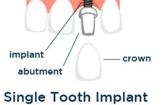 Multiple Teeth Implants By Eon Clinics In Chicago Il Alignable