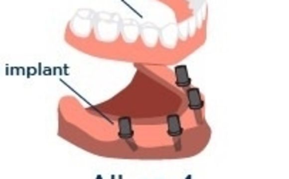 Multiple Teeth Implants By Eon Clinics In Chicago Il Alignable