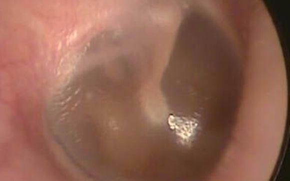 Ear Cleaning by RK Audiology - South Austin